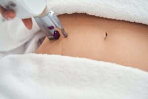 Woman coming to clinic for removing scar on belly
