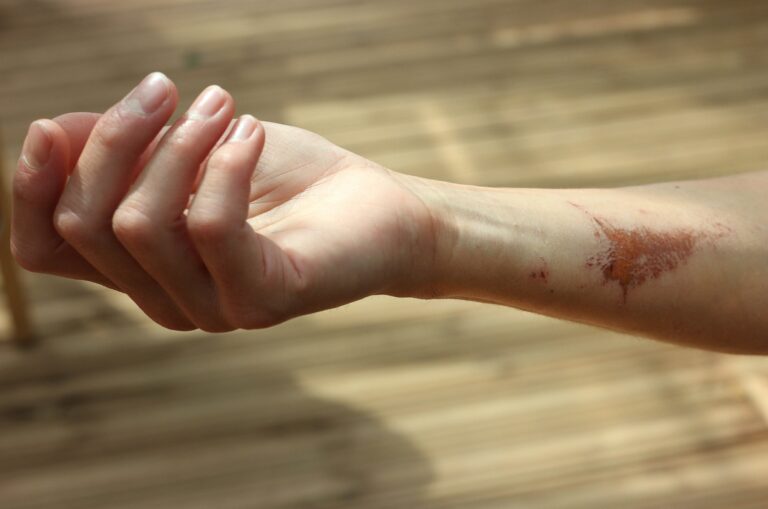 Woman's hand with scar